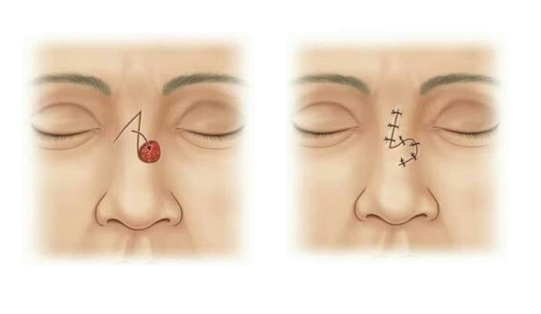 What to Expect During Nasal reconstruction recovery